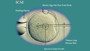 icsi (intracytoplasmic sperm injection)即卵胞浆内单精子注射技术