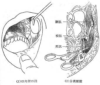 化脓性腮腺炎