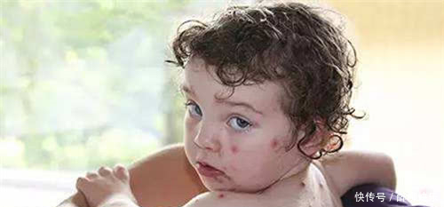 小孩出水痘发烧怎么办出水痘发烧能吃退烧药吗