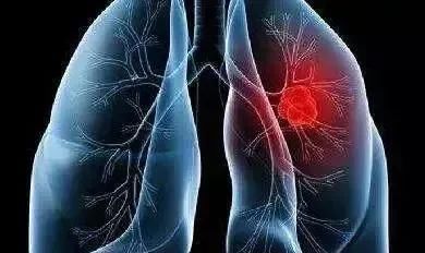 肺癌的早期症状有哪些?