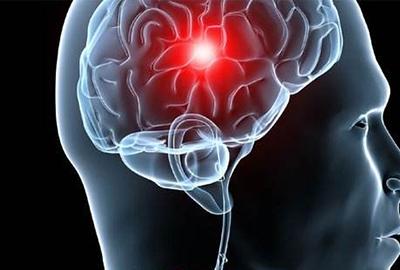 弱激光体外血液净化降低高血压脑出血发病率,