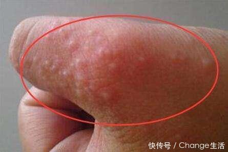 一到夏天手上就长小水泡,身体这里出问题了,你