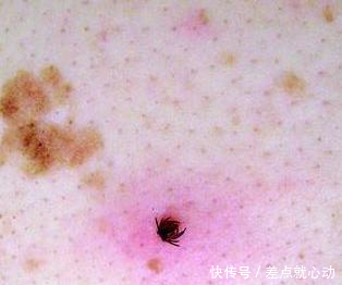 春夏季节带狗狗外出时狗狗不小心被蜱虫叮咬了