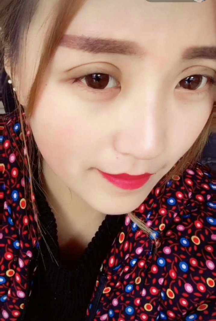 术后恢复八十三天的双眼皮,前后对比的差距有