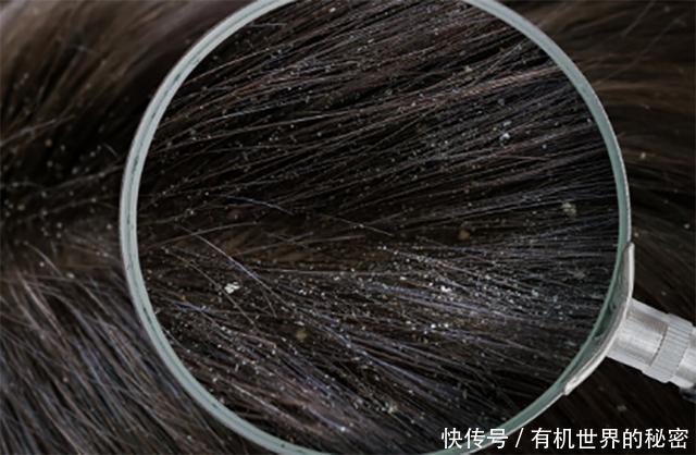 洗头后,拨开头发一看密密麻麻全是头皮屑,2招教你轻松去除它!