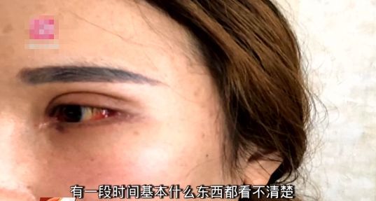 21岁女子割双眼皮开眼角后,眼睛红痛视力模糊
