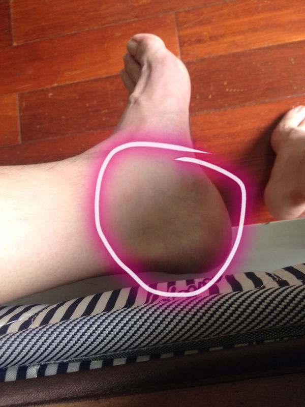 我的左脚在一次打篮球的时候抢板后落地后顿了