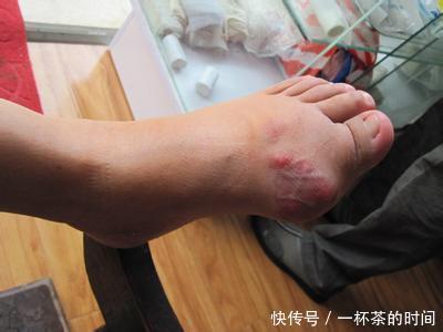 身体尿酸太高,促排泄是关键,1种食物要多吃!