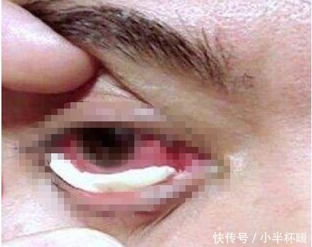 男子眼睛不舒服揉出白色石头,去医院检查,听了医生的话后背发凉