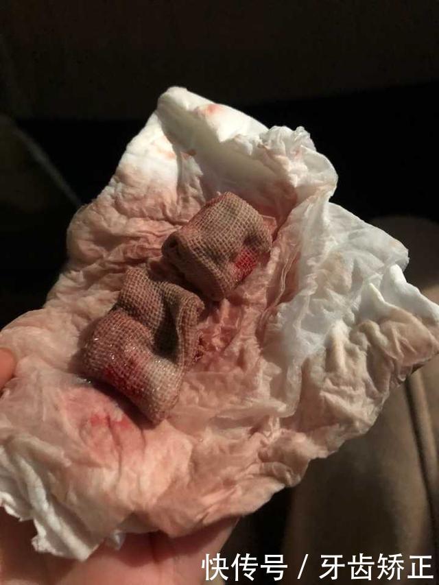 牙套小萌新的整牙日记:龅牙,短下巴,拔四颗牙