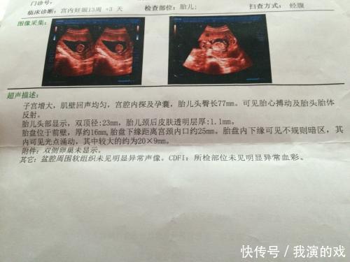 怀孕看B超单的两数据,了解胎儿重要信息,孕妈