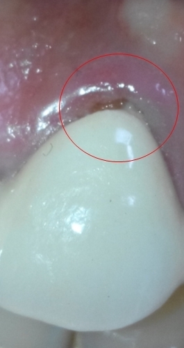 做烤瓷牙之前戴的临时牙把牙龈顶高了会不会恢