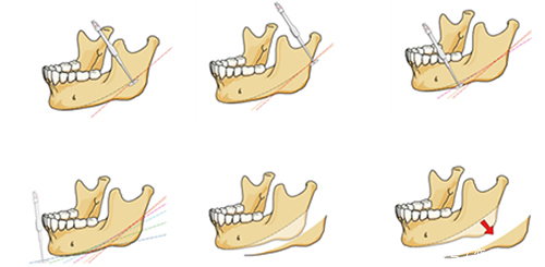 改脸型的轮廓整形在韩国怎么样?