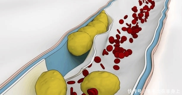 低密度脂蛋白偏高脑梗塞, 推荐4食物清除血液