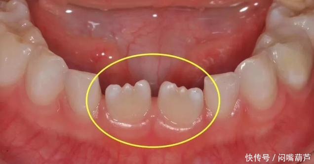 小孩牙齿为什么呈锯齿状?