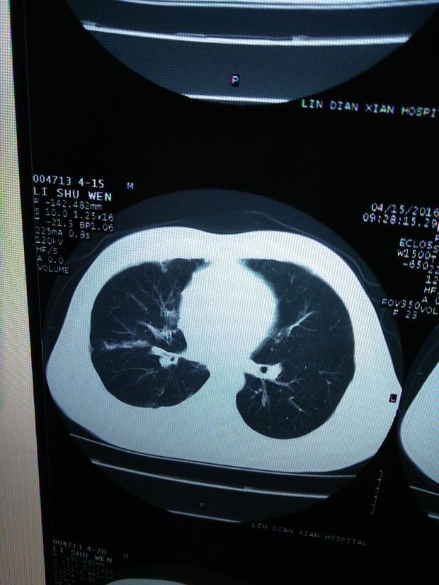 我爸爸肺癌请问他的癌症病灶是在肺门吗?能做一刀切出手术吗?