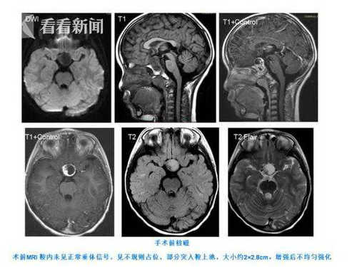 国内首例经鼻内窥镜下儿童颅咽管瘤切除手术成功