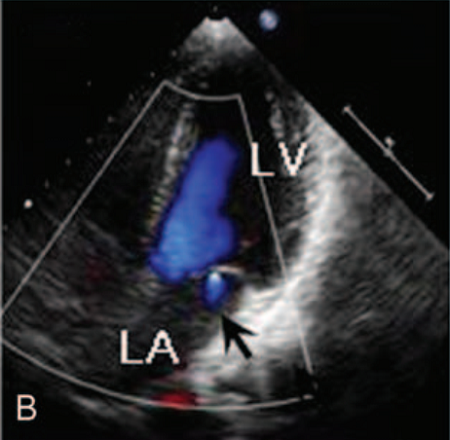 屋漏偏逢连夜雨,心肌致密化不全合并心肌桥