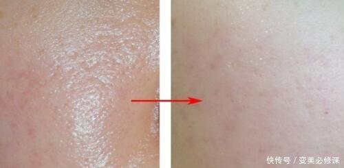 什么是皮秒激光?做一次有效果吗?