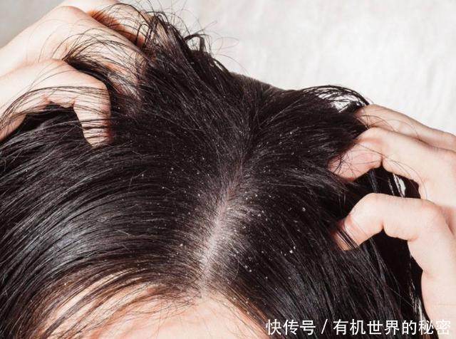 头皮油能抠下灰泥,说明几万螨虫扎根毛孔,再不