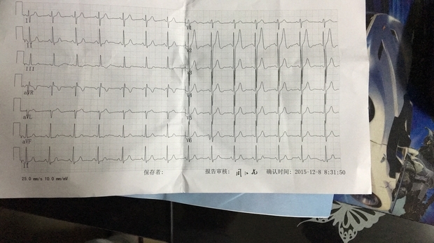 心电图电轴右偏尖,t波高尖,心电图p-r间期113ms,有什么问题吗,严重吗