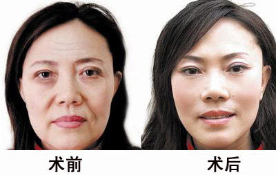 面部除皱新方法?_360问答