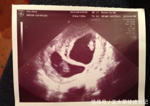 23岁孕妈生下龙凤胎要缝合,突然大喊等下,护