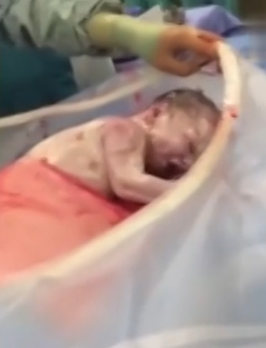 医生为孕妇剖腹后让婴儿自己爬出母体 - 谭笑古今 - 谭笑古今 医生为孕妇剖腹后让婴儿自己爬出母体 - 谭笑古今 - 谭笑古今