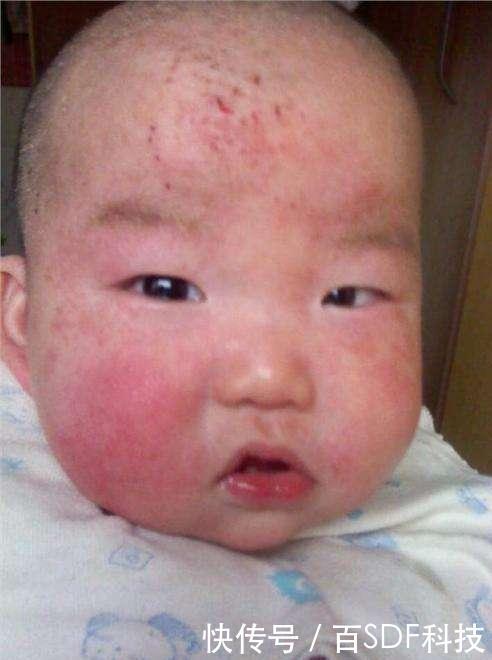 六个月宝宝吃蒸蛋,长满红斑浑身发烫,去医院之