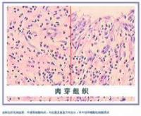 也有多少不等的中性粒细胞及淋巴细胞,因此肉芽组织具有抗感染功能