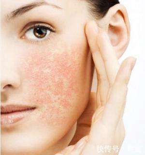敏感肌是什么?科痘带你了解!_【快资讯】