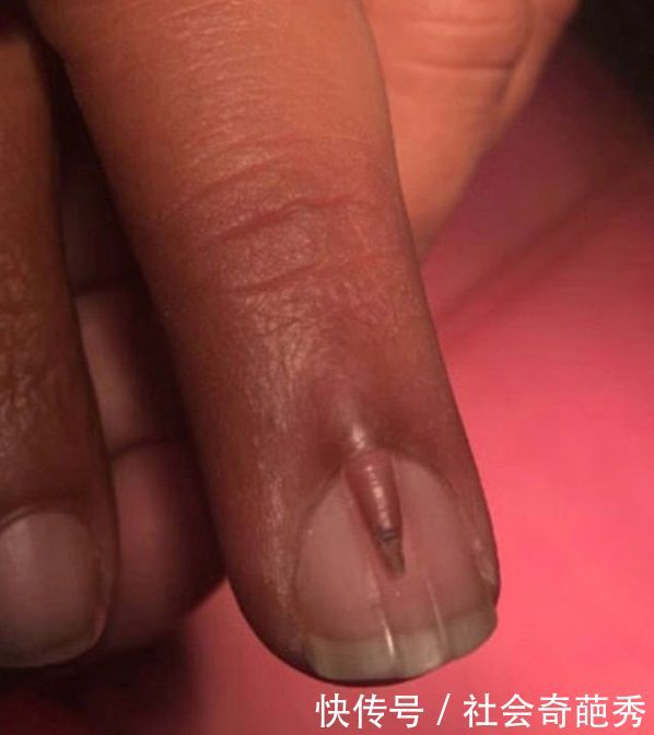 男子指甲盖上长出小指甲,去医院检查,引发国际医学界关注