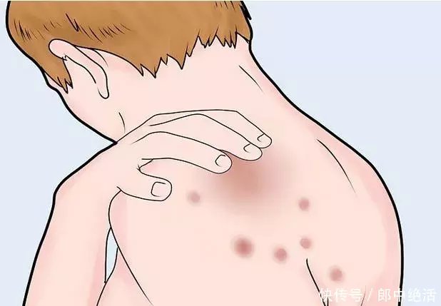 急、慢性荨麻疹及丘疹性荨麻疹患者过敏原特异