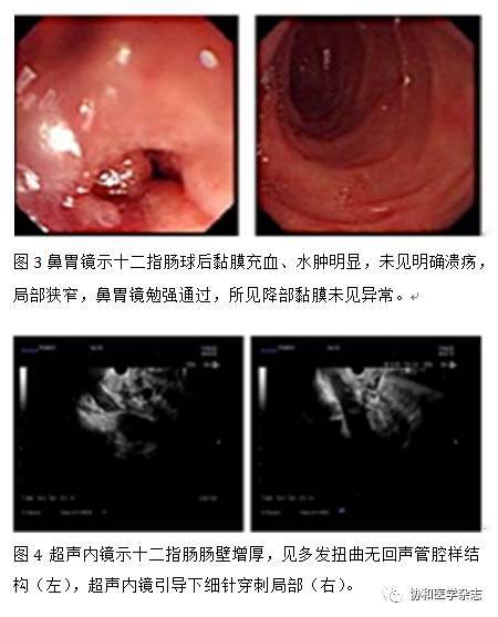 协和病例:上消化道梗阻、黄疸、胰腺病变，是……