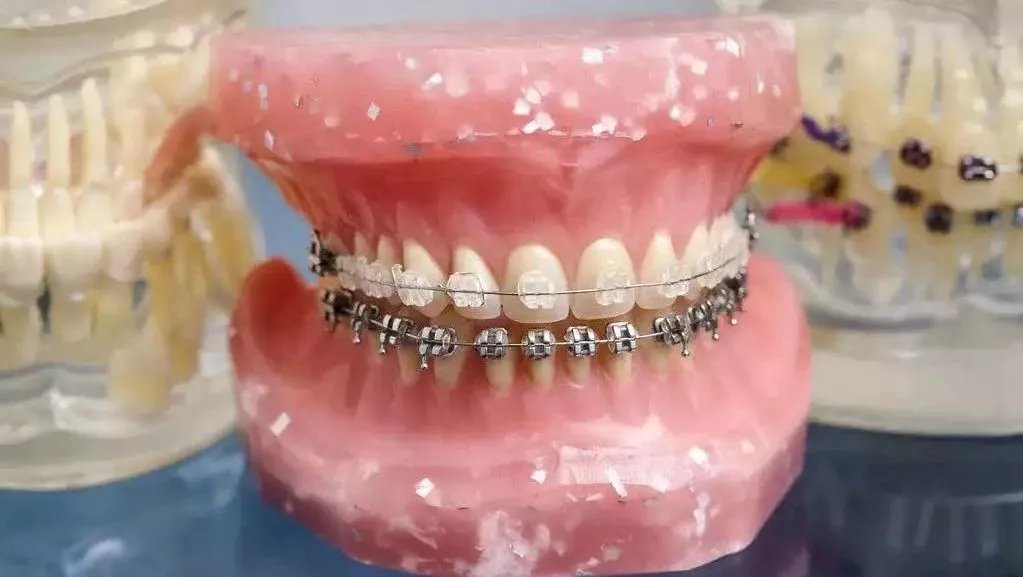 我的虎牙长得很丑,为什么医生不让我拔掉?