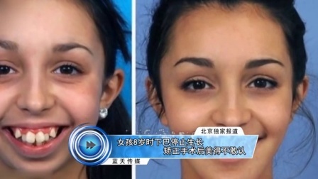蓝天娱乐快报 2016 7月 女孩8岁时下巴停止生长 矫正手术后美得不敢认 160726