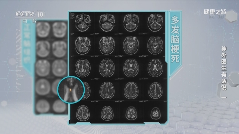 健康之路 《健康之路》 20221024 神外医生有话说（一）