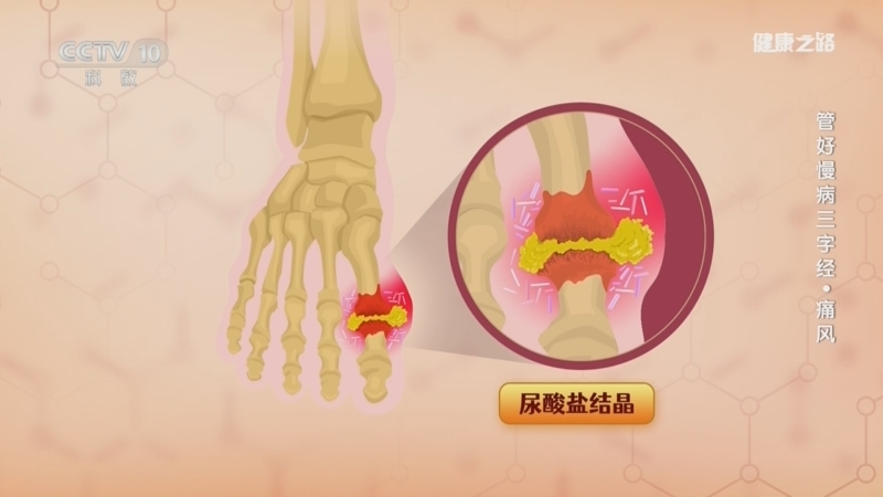 健康之路 《健康之路》 20240824 管好慢病三字经·痛风