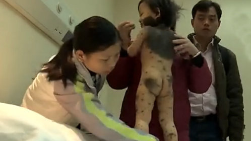 鲁豫有约 宝宝得罕见病全身长黑猫斑似熊猫