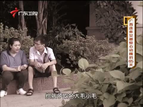 凡人大爱 《凡人大爱》 20131202 广西连体女婴惊心动魄的65天