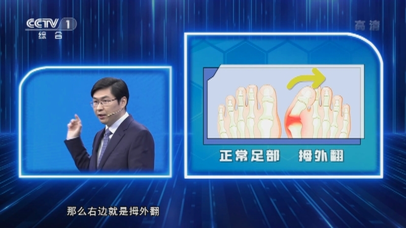 《人口》 20210811 如何远离拇外翻