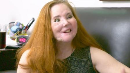 半岛奇闻 美国女子吞枪自杀未遂，却摧毁了半张脸，至今做49次面部重建手术