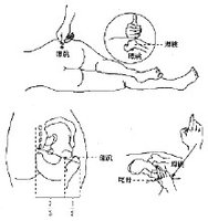 尤其是坐骨神經痛患者,其症狀以太陽經和少陽經循行部位疼痛最多,對該