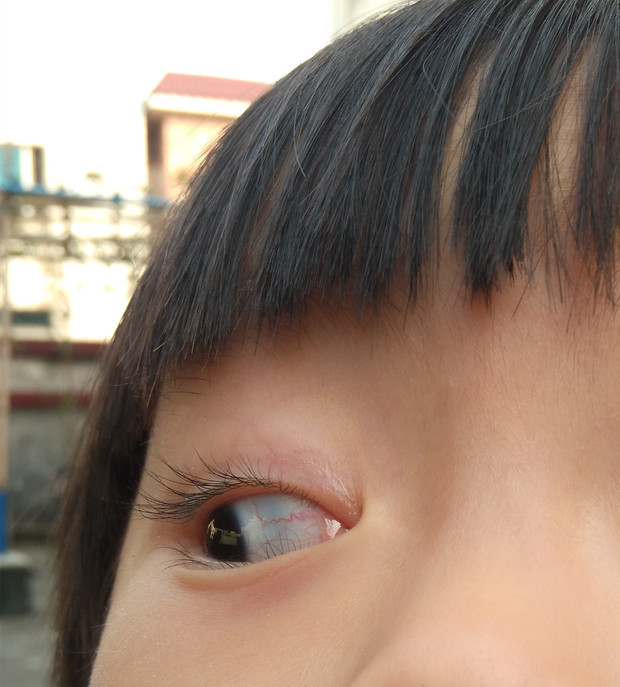 小孩眼睛红血丝图片图片