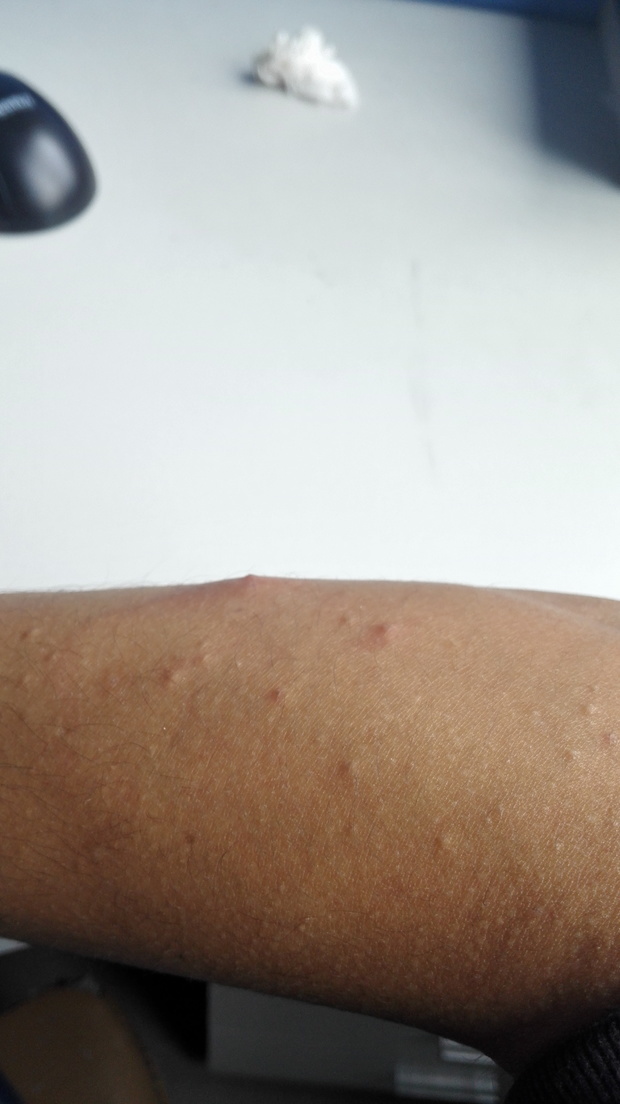 拒绝辣椒,拒绝酒精.中药调理 化妆品涂抹 肺:辣椒吃的挺多的.