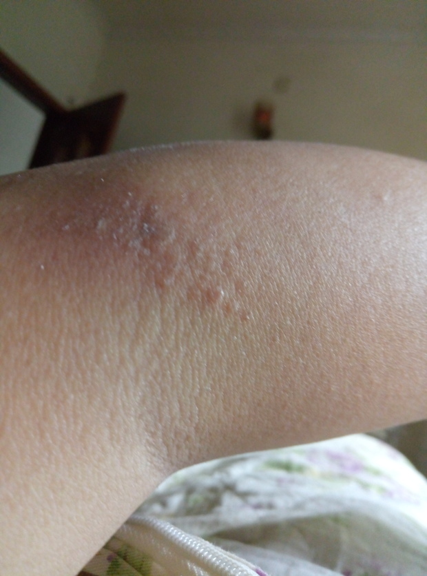 胳膊肘突然有点刺痛,然后起了一些小包块.