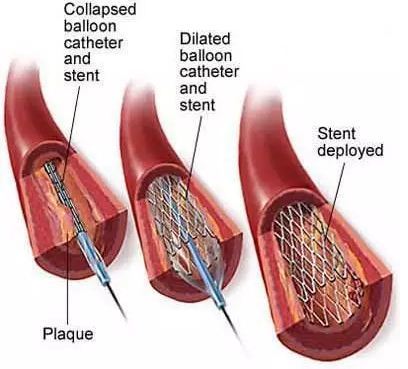 国产工业化心脏支架飞秒激光高精细加工设备面世 可达