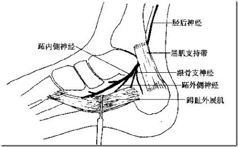 腳底筋膜炎